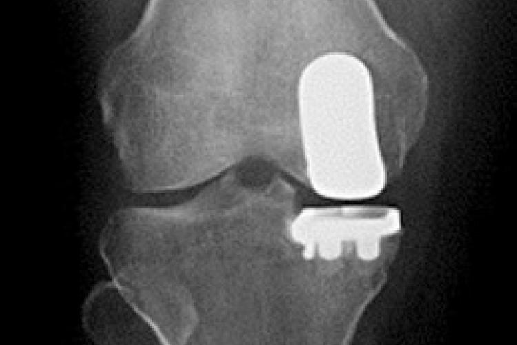 Robotic technology is a vital part of knee replacement surgery The